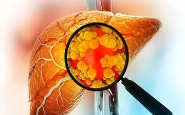 چه داروهایی بر کبد چرب تاثیر مضاعف دارد؟