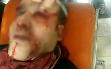 
دو مورد تخلیه چشم در شهرستانهای قرچک و شهریار