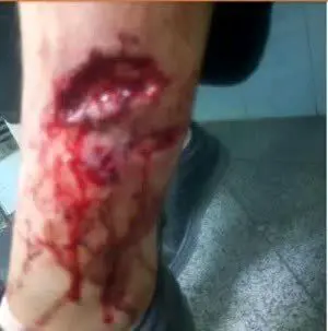 تصاویر دلخراش از حمله سگ‌های ولگرد به یک دختر دانش‌آموز | عکس