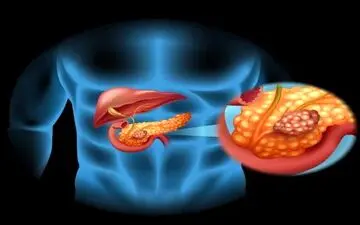 سرطان لوزالمعده چه علائمی دارد؟

