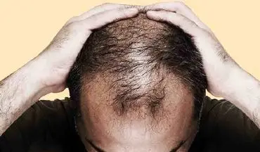 خطر ریزش مو در کمین کارکنان شیفت شب!