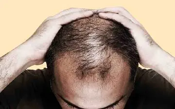 خطر ریزش مو در کمین کارکنان شیفت شب!