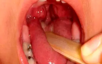 علائم ورم لوزه