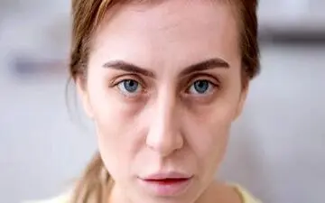 کمبود این ویتامین باعث رنگ پریدگی می‌شود 