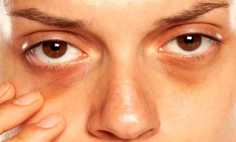 رفع تیرگی دور چشم در سه روز