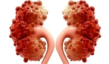 درد مبهم در پهلوها را جدی بگیرید: کیست کورتیکال چیست و چه زمانی خطرناک می‌شود؟