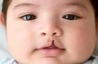 چرا بعضی از کودکان با لب شکافته متولد می‌شوند؟