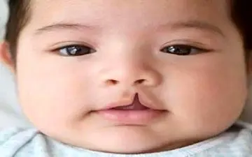 چرا بعضی از کودکان با لب شکافته متولد می‌شوند؟