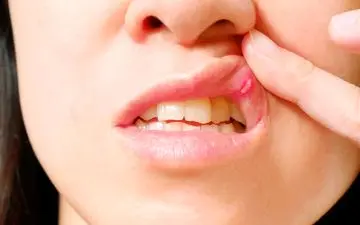 دلایل اصلی بروز آفت‌های مکرر دهان + ویدئو