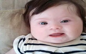 ردپای سندرم داون در دوران جنینی