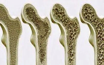 پوکی استخوان بدلیل کمبود کلسیم نیست