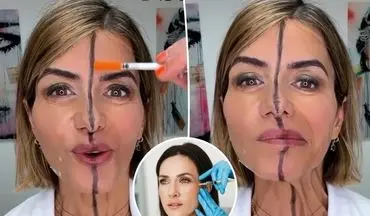 تزریق بوتاکس فقط به یک سمت صورت؛ آزمایشی متفاوت برای نمایش تأثیر واقعی +عکس