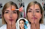 تزریق بوتاکس فقط به یک سمت صورت؛ آزمایشی متفاوت برای نمایش تأثیر واقعی +عکس