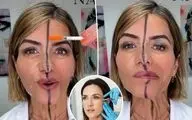 تزریق بوتاکس فقط به یک سمت صورت؛ آزمایشی متفاوت برای نمایش تأثیر واقعی +عکس