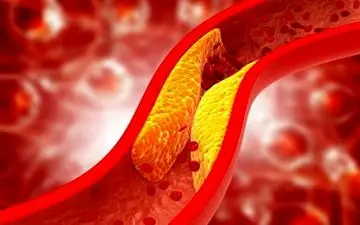 چند نشانه گرفتگی عروق که خیلی ها نمیدونن