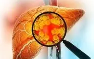 رابطه  PCOS با ابتلا به  کبد چرب!