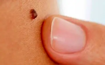 هشدار|مراقب خال‌های بدنتان باشید!