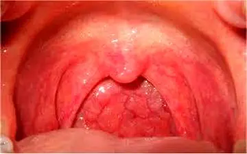 اگر گلودرد با خمیازه بدتر شود نشانه چیست؟