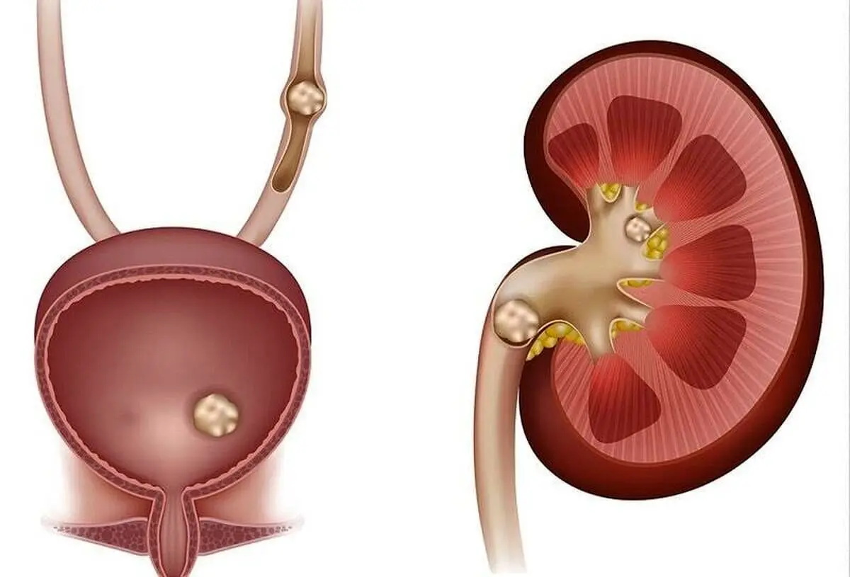 سنگ کلیه را اینگونه درمان کنید!