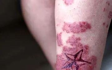 مراقبت‌های بعد از انجام تاتو