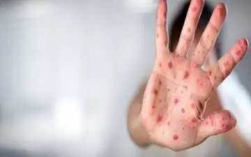 تست 3 مورد مشکوک به آبله میمونی در اصفهان منفی اعلام شد