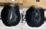 کشف روشی ساده برای درمان طاسی با نتایج چشمگیر در تنها هشت هفته!