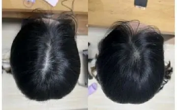  کشف روشی ساده برای درمان طاسی با نتایج چشمگیر در تنها هشت هفته!