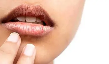 خشکی دهان چه دلایلی دارد؟