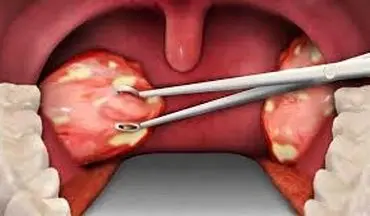علت ایجاد سرطان لوزه چیست؟