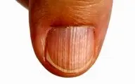 خطوط عمودی و افقی روی ناخن/ ناخن‌ها چه رازهایی درباره‌ی سلامتی شما فاش می‌کنند؟