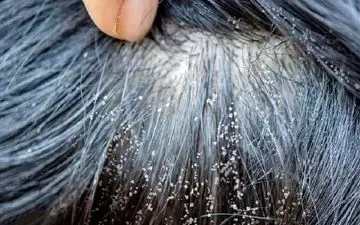 متهم ردیف اول ایجاد شپش را بشناسید