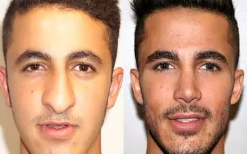  تغییرات باورنکردنی در چهره مردان؛ عمل‌ زیبایی فقط برای خانم‌ها نیست!