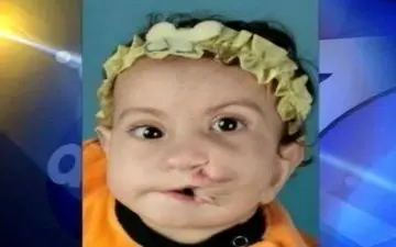 جراحی عجیب دختری که دو دهان دارد