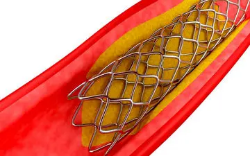 چه زمانی فنر زدن رگ های قلب لازم است؟