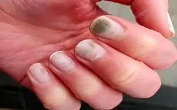 ارتباط شکل ناخن با کلسترول