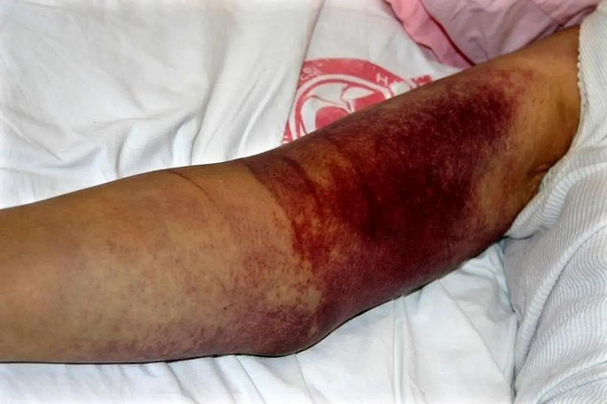 شناسایی ۱۸ بیمار مبتلا به تب کریمه کنگو در ایران | علائم چیست و چگونه از ابتلا به بیماری پیشگیری کنیم؟