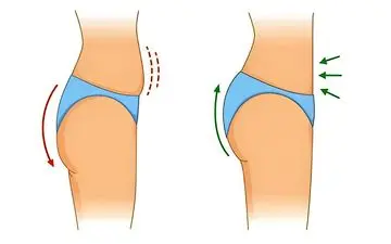 جراحی فرم‌دهی باسن با چربی بدن خودتان: همه‌چیز درباره عمل ترانسفر