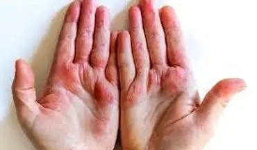چگونه با  اگزما  مقابله کنیم ؟|  اگزما در کودکان
