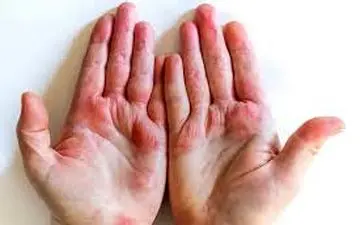 چگونه با  اگزما  مقابله کنیم ؟|  اگزما در کودکان