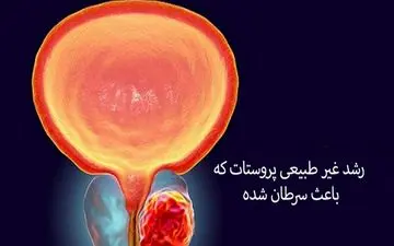 رابطه افزایش فعالیت جنسی با سرطان پروستات