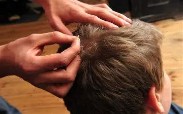 شپش سر و درمان‌های رایج آن/چگونه شپش منتقل می‌شود؟