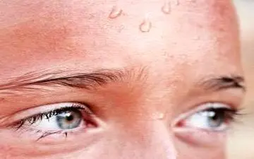 چه موقع عرق کردن بیماری محسوب می شود؟