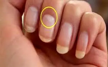 
رنگ ماهک ناخن شما، خبر از بیماری می‌دهد
