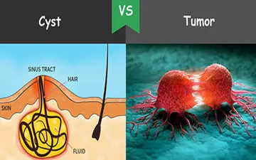 فرق بین کیست و تومور چیه؟