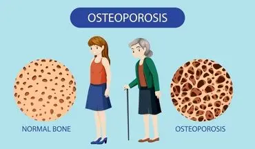 میانسالی، نقطه بی‌بازگشت سلامت استخوان: چرا باید پیش از ۳۰ سالگی برای حفظ توده استخوانی اقدام کرد؟