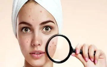 4 نوشیدنی که آکنه شما را از بین می برد