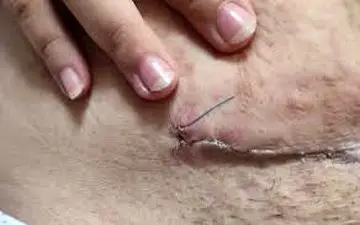 روش‌های درمانی  عفونت بخیه سزارین