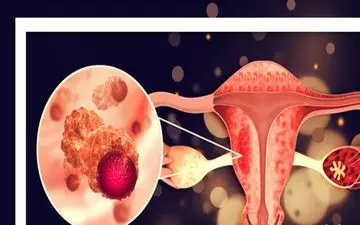 یک جراحی ساده که خطر سرطان تخمدان را تا ۸۰ درصد کاهش می‌دهد