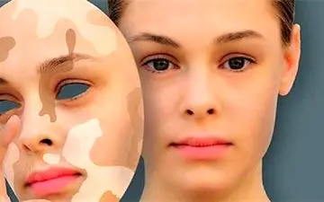 ویتیلیگو چیست و گریبانگیر چه کسانی می‌شود؟