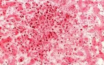 این تب خونریزی به همراه دارد